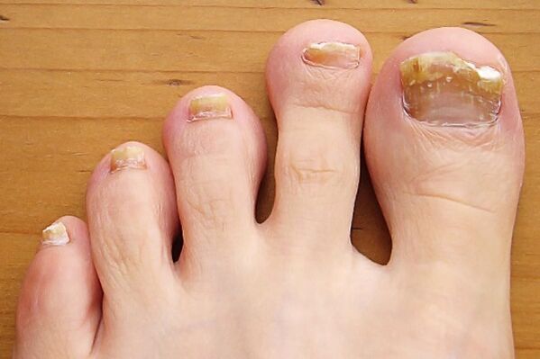 tratament de baie ciuperca unghiilor piciorului tratamentul ciupercii unghiilor în medicina populară
